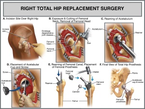 total-hip-replacement-vizag